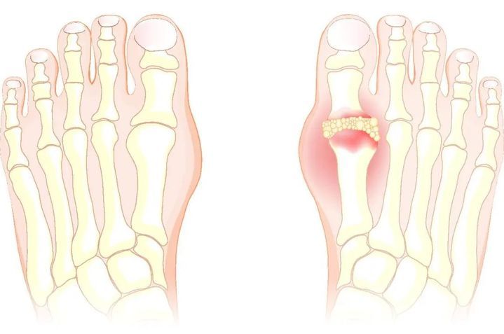 七日食谱，助你度过痛风急性发作期！