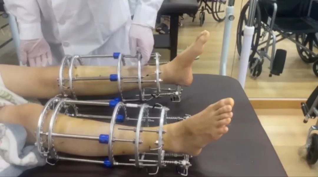 所有不幸都来自身高？“断骨增高”后的人：没有一天不后悔