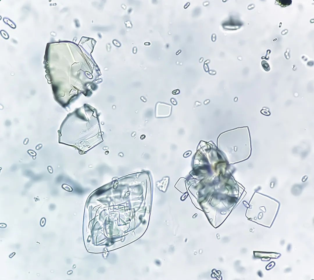 “10后”已经开始痛风了?15岁男孩尿酸爆了!医生紧急提醒 “10后”已经开始痛风了?15岁男孩尿酸爆了!医生紧急提醒