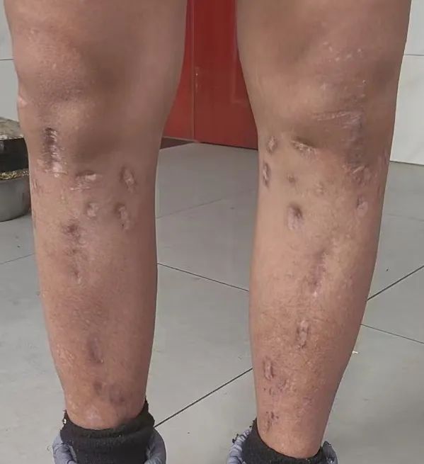 所有不幸都来自身高？“断骨增高”后的人：没有一天不后悔