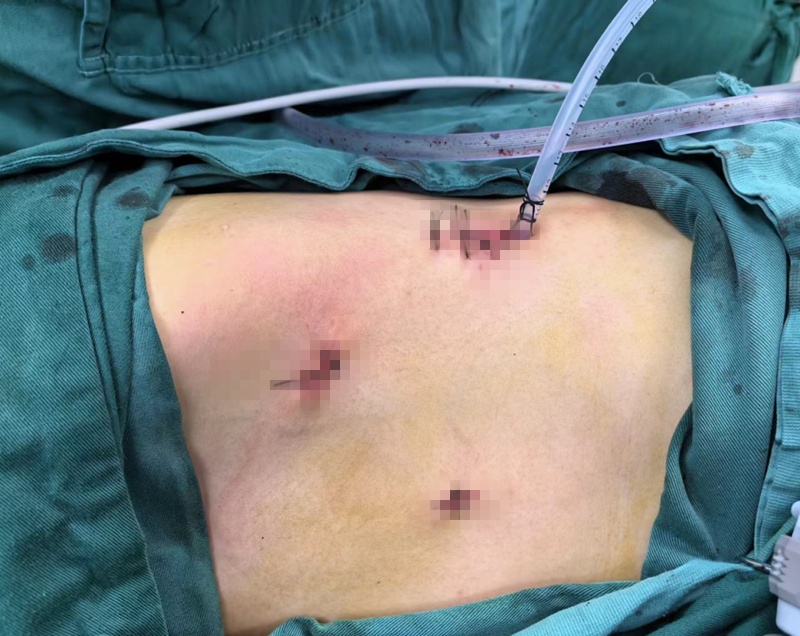 福州37岁男子脚趾差点没了!医生:这个习惯必须改! 福州37岁男子脚趾差点没了!医生:这个习惯必须改!