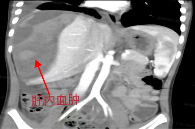 6岁男孩玩滑板车摔倒致肝脏破裂,暑假儿童肝外伤患儿增加不少 6岁男孩玩滑板车摔倒致肝脏破裂,暑假儿童肝外伤患儿增加不少