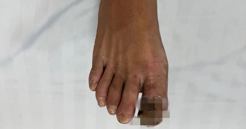 福州37岁男子脚趾差点没了!医生:这个习惯必须改! 福州37岁男子脚趾差点没了!医生:这个习惯必须改!