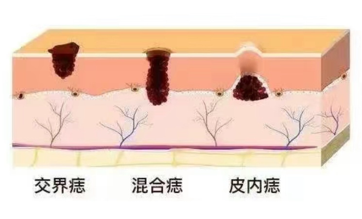 黑痣“变形记”，警惕恶变的五大信号！