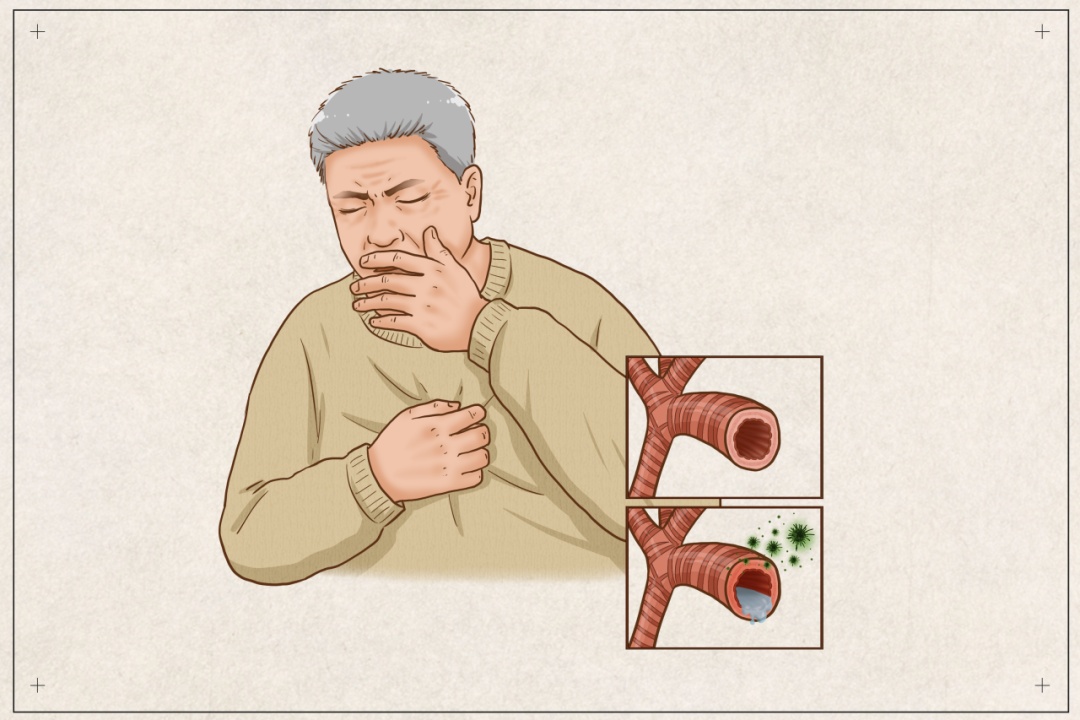 季节性支气管炎来袭,如何保护呼吸系统? 季节性支气管炎来袭,如何保护呼吸系统?