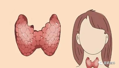 折翼的蝴蝶——甲状腺癌