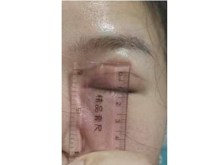 女子做双眼皮手术,结果有12毫米宽!绷不住了:朋友说我像“悲伤蛙” 女子做双眼皮手术,结果有12毫米宽!绷不住了:朋友说我像“悲伤蛙”