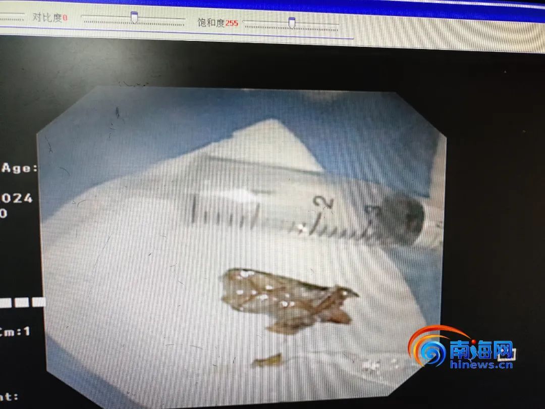 男子睡梦中,虫子钻进鼻腔被呛到气管!医生:是蟑螂 男子睡梦中,虫子钻进鼻腔被呛到气管!医生:是蟑螂