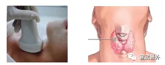 折翼的蝴蝶——甲状腺癌