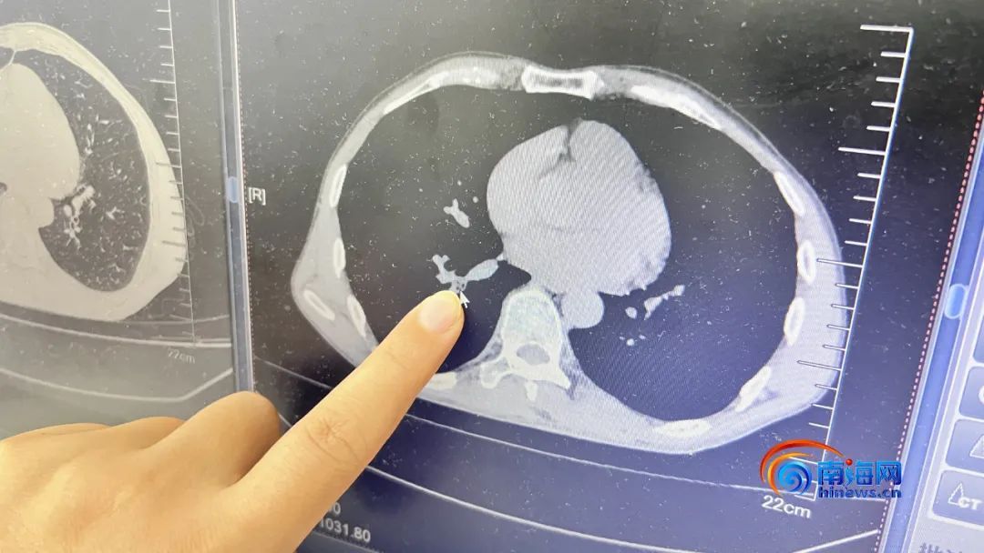 男子睡梦中,虫子钻进鼻腔被呛到气管!医生:是蟑螂 男子睡梦中,虫子钻进鼻腔被呛到气管!医生:是蟑螂