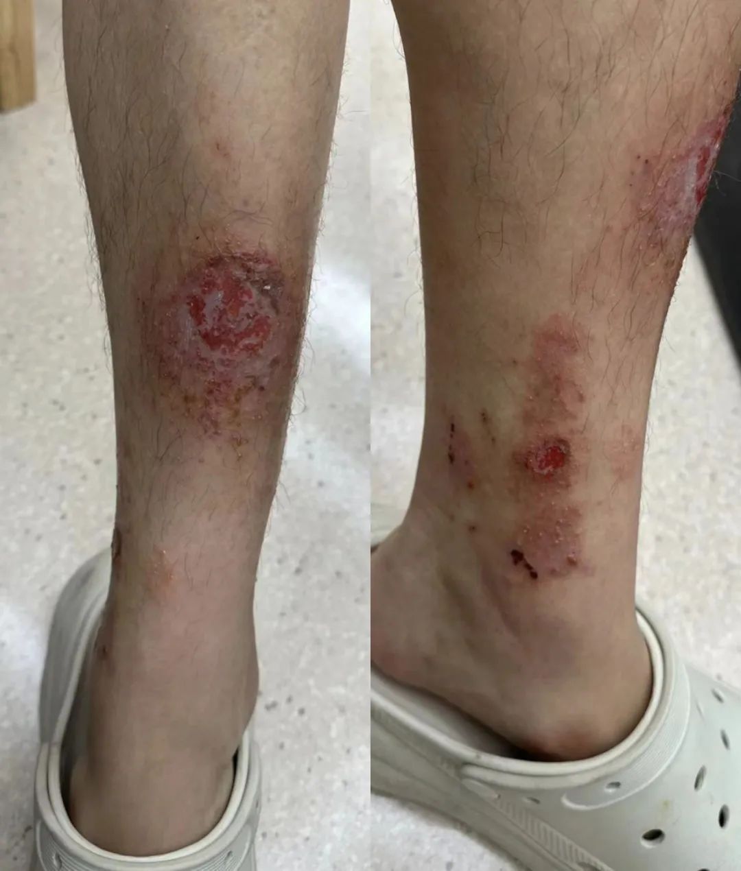 和女朋友游完西湖，男子双腿溃烂！医生：你对自己是真狠