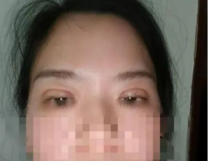 女子做双眼皮手术,结果有12毫米宽!绷不住了:朋友说我像“悲伤蛙” 女子做双眼皮手术,结果有12毫米宽!绷不住了:朋友说我像“悲伤蛙”