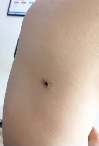 速查!身上出现这种周围泛红的“焦痂”,不要忽视请立刻就医! 速查!身上出现这种周围泛红的“焦痂”,不要忽视请立刻就医!