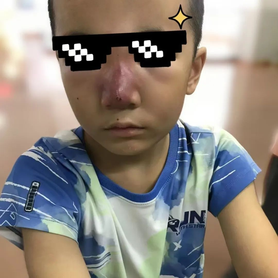 发高烧！7岁男孩确诊 医生：严重可致命