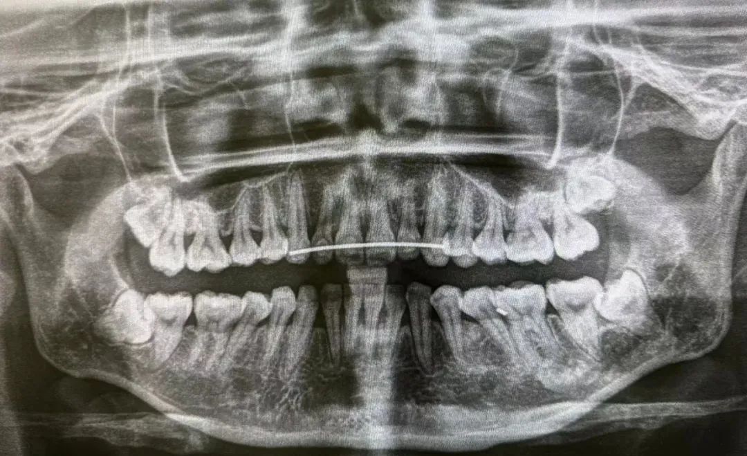 近期火热！多人摔伤，有人磕掉3颗牙！医生紧急提醒