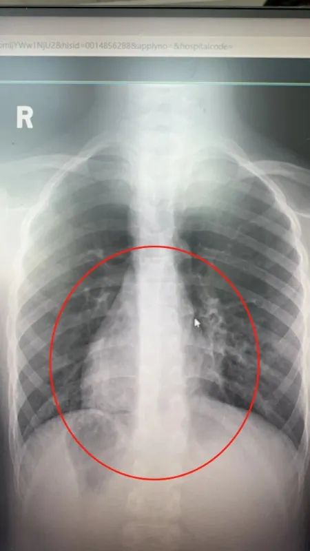 心脏在右，肝胆在左，医生“反手”为“镜像人”切除阑尾