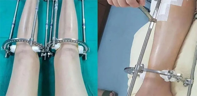 别被“断骨增高”忽悠瘸了