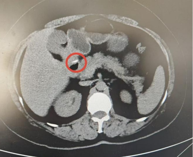 女子鱼刺卡喉，一个动作引发腹痛、发烧、胃穿孔……