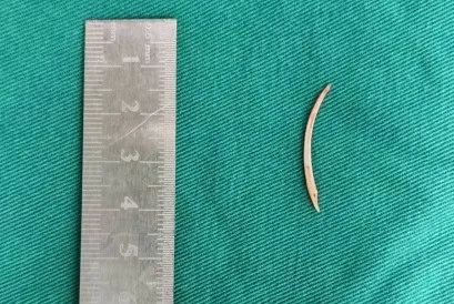 女子鱼刺卡喉，一个动作引发腹痛、发烧、胃穿孔……