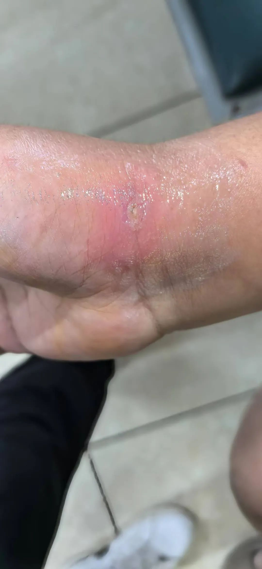 揪心!女子被章鱼叮咬,13天后就医!医生:最怕的是感染这种细菌…… 揪心!女子被章鱼叮咬,13天后就医!医生:最怕的是感染这种细菌……