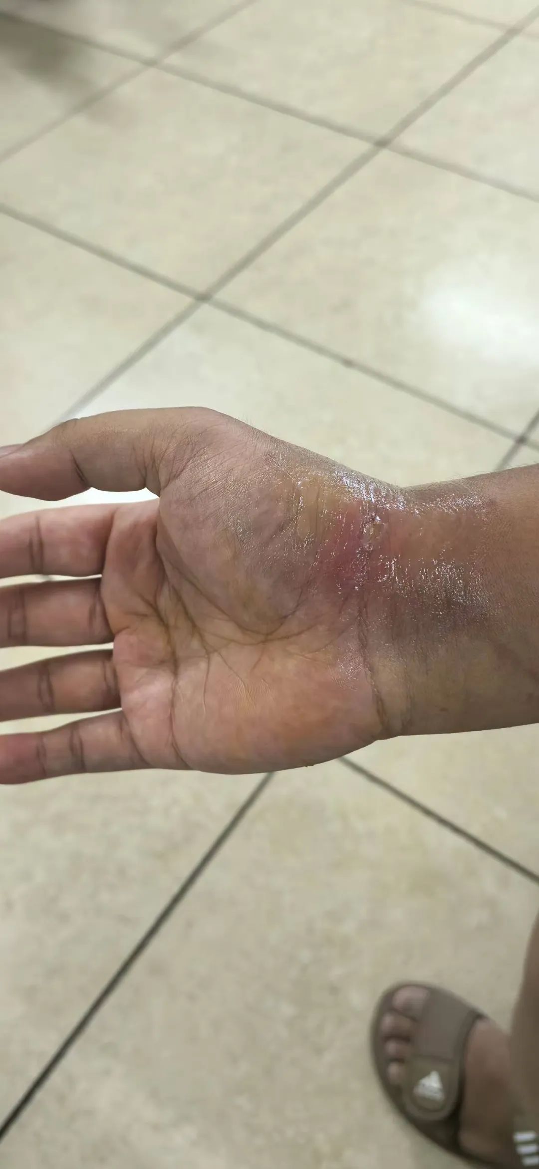 揪心!女子被章鱼叮咬,13天后就医!医生:最怕的是感染这种细菌…… 揪心!女子被章鱼叮咬,13天后就医!医生:最怕的是感染这种细菌……