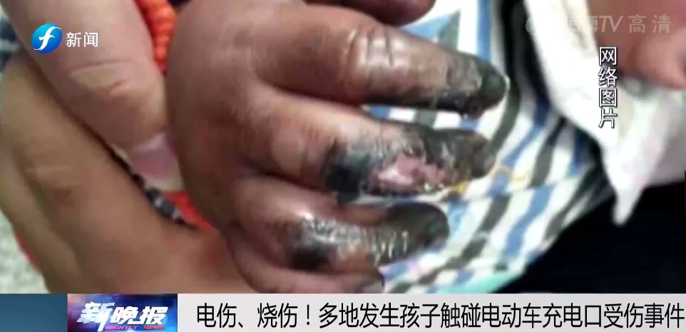 揪心!1岁宝宝手指瞬间烧黑…… 揪心!1岁宝宝手指瞬间烧黑……