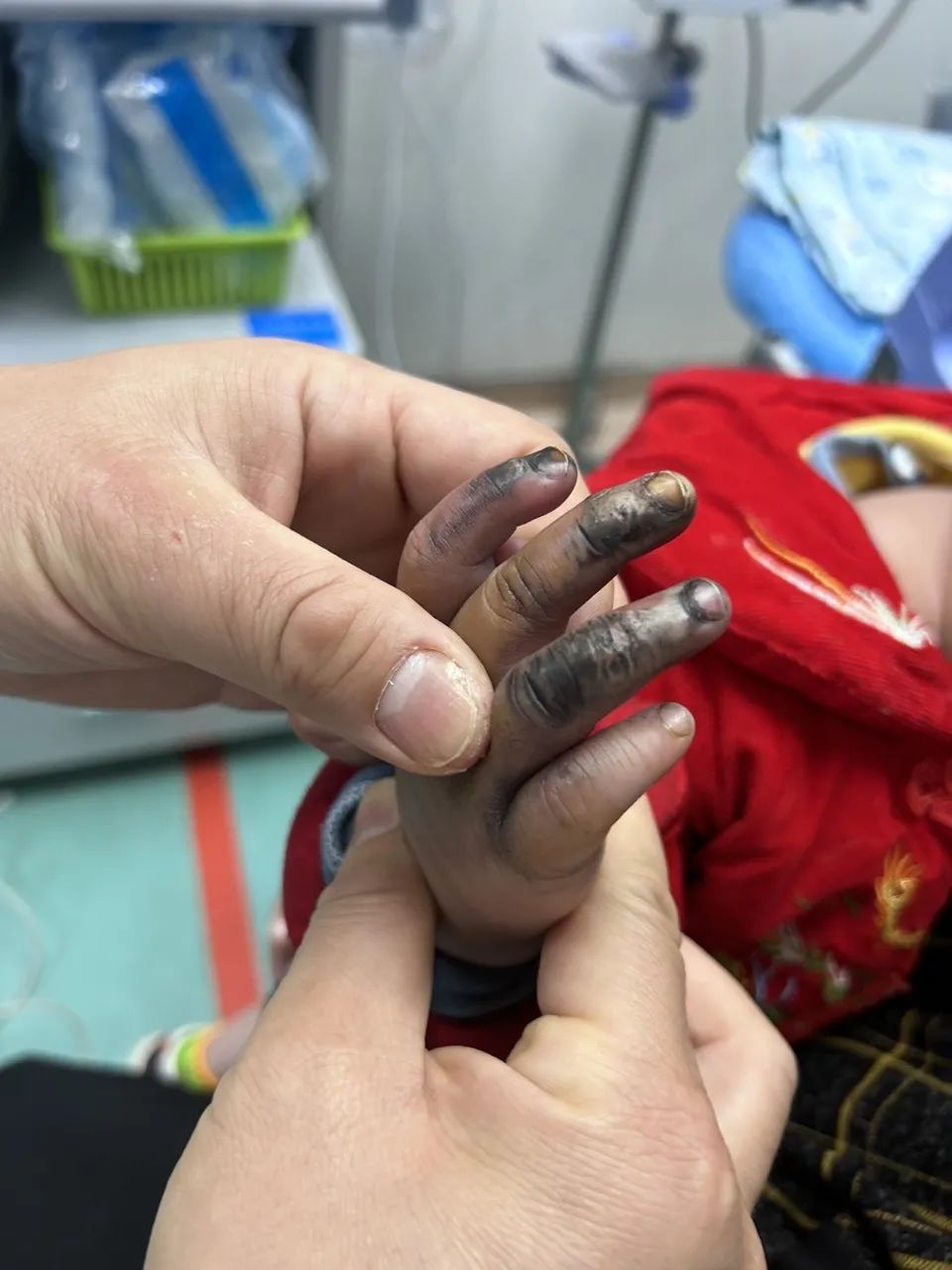 揪心!1岁宝宝手指瞬间烧黑…… 揪心!1岁宝宝手指瞬间烧黑……