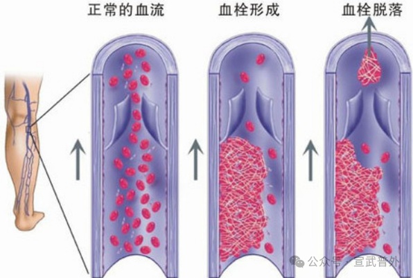 踝泵运动小指南