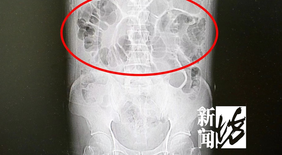 粪便把肠子戳破?男子在沪紧急就医,差点没命!越来越常见!很多人有误区→ 粪便把肠子戳破?男子在沪紧急就医,差点没命!越来越常见!很多人有误区→