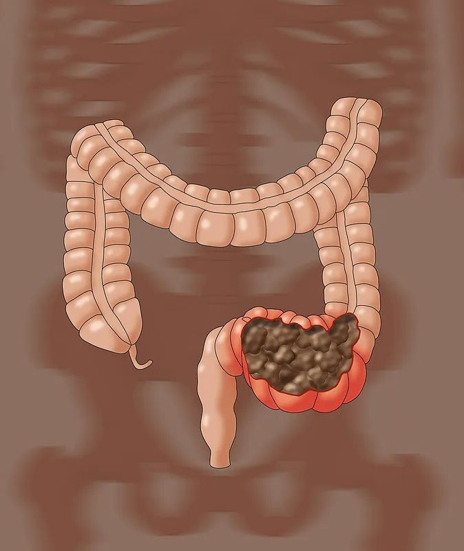 粪便把肠子戳破?男子在沪紧急就医,差点没命!越来越常见!很多人有误区→ 粪便把肠子戳破?男子在沪紧急就医,差点没命!越来越常见!很多人有误区→