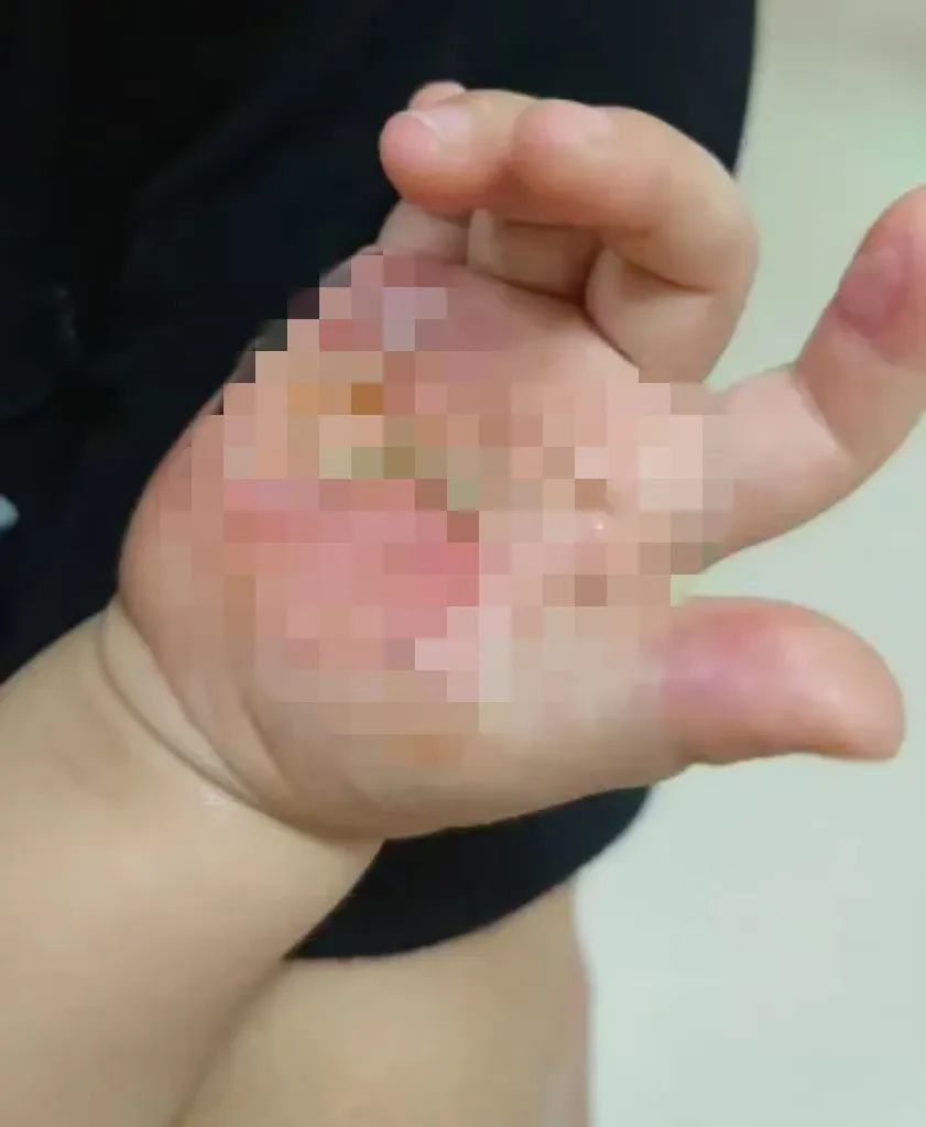 痛! 摸了一下, 手掌皮肤像"被融了"! 最近高发, 务必警惕! 痛! 摸了一下, 手掌皮肤像"被融了"! 最近高发, 务必警惕!