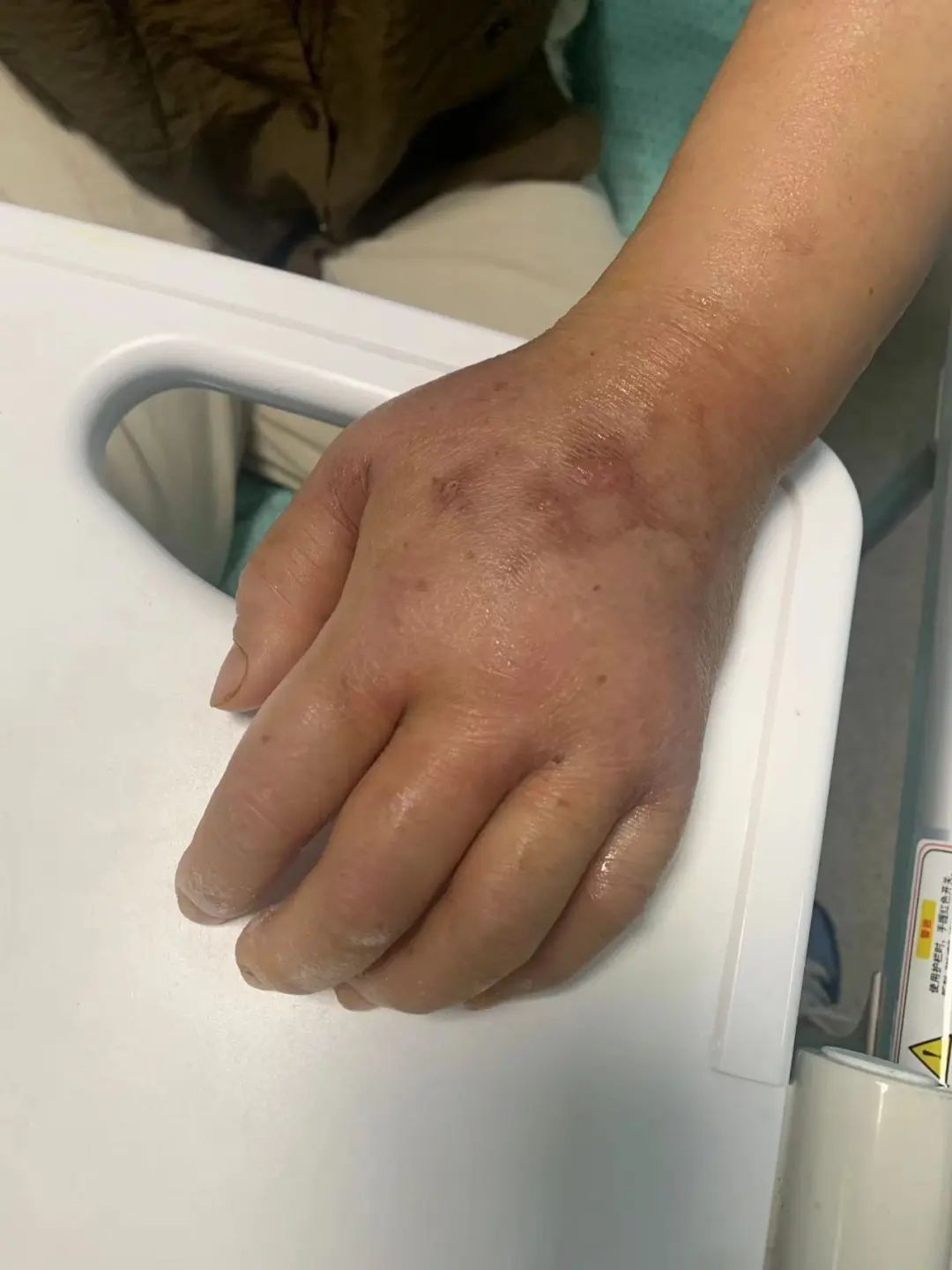 为了一道菜，浙江女子差点截肢！这种情况，死亡率近100%