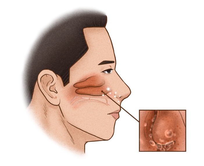 浅谈过敏性鼻炎的防治 浅谈过敏性鼻炎的防治