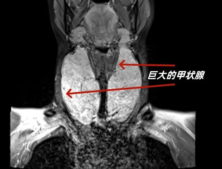 陡然40.5°C，女西席抽搐晕厥！上海瑞金病院：她体内有个"定时炸弹"！