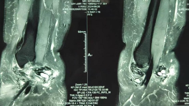 有人体内长出大量绒毛，犹如螃蟹脚！专门盯这类人群