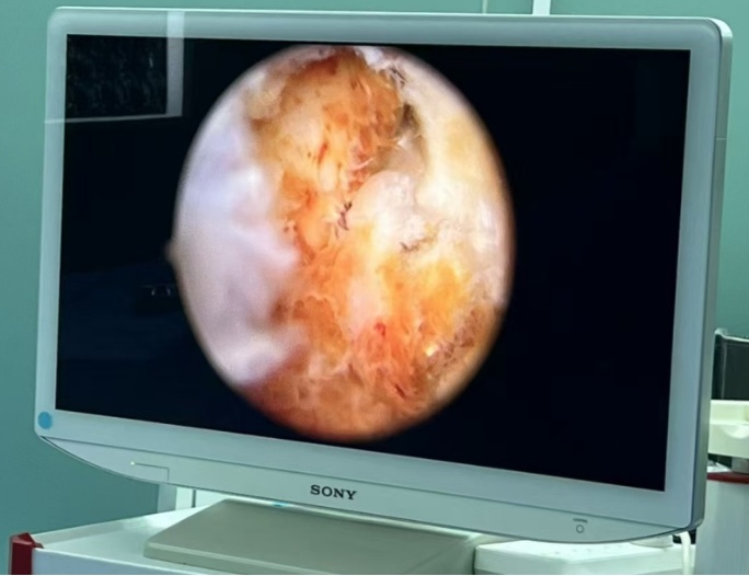 有人体内长出大量绒毛，犹如螃蟹脚！专门盯这类人群