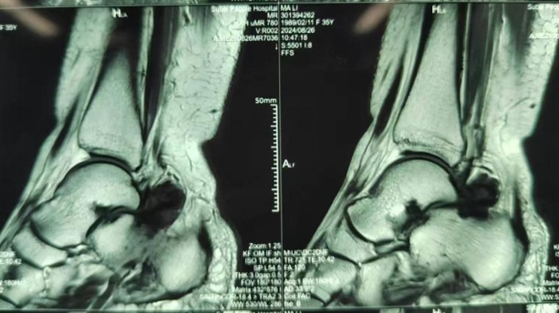 有人体内长出大量绒毛，犹如螃蟹脚！专门盯这类人群