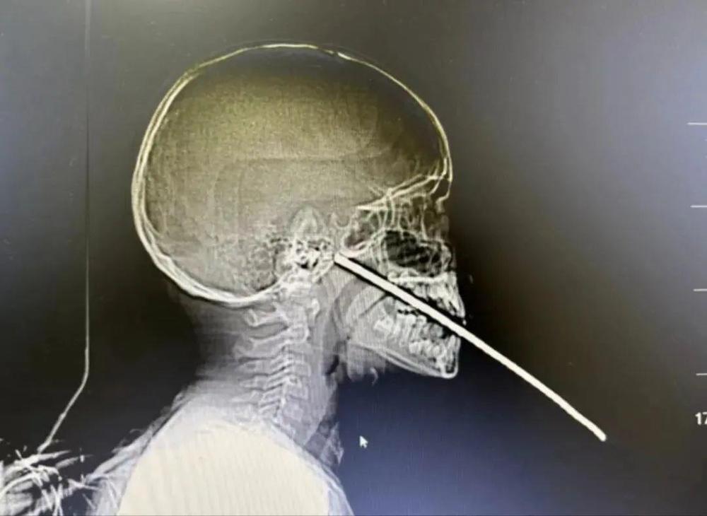 车把手插入男孩腹部!利器贯穿伤急救“5要点”要记牢 车把手插入男孩腹部!利器贯穿伤急救“5要点”要记牢