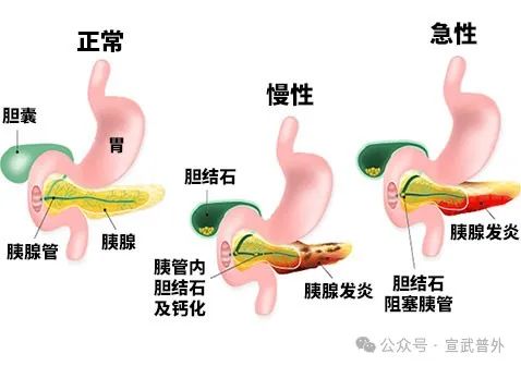 如何区别胃疼和急性胰腺炎的疼痛? 如何区别胃疼和急性胰腺炎的疼痛?