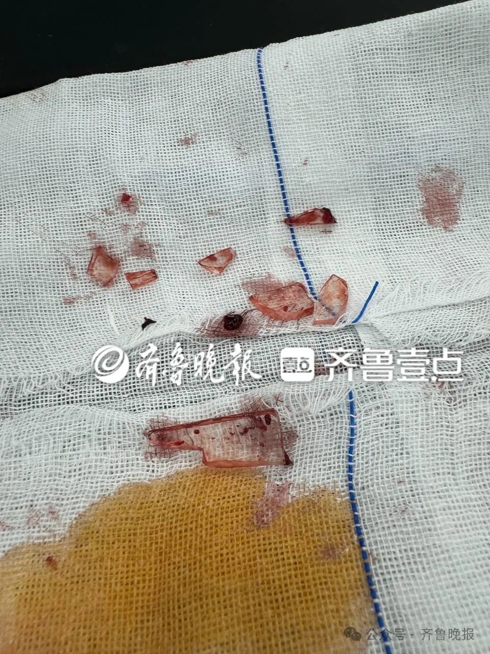 突然爆炸，男童全脸30多处伤！千万别这么玩