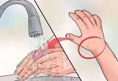 当心!逛完公园,这种“小黑点”钻进头皮...... 当心!逛完公园,这种“小黑点”钻进头皮......