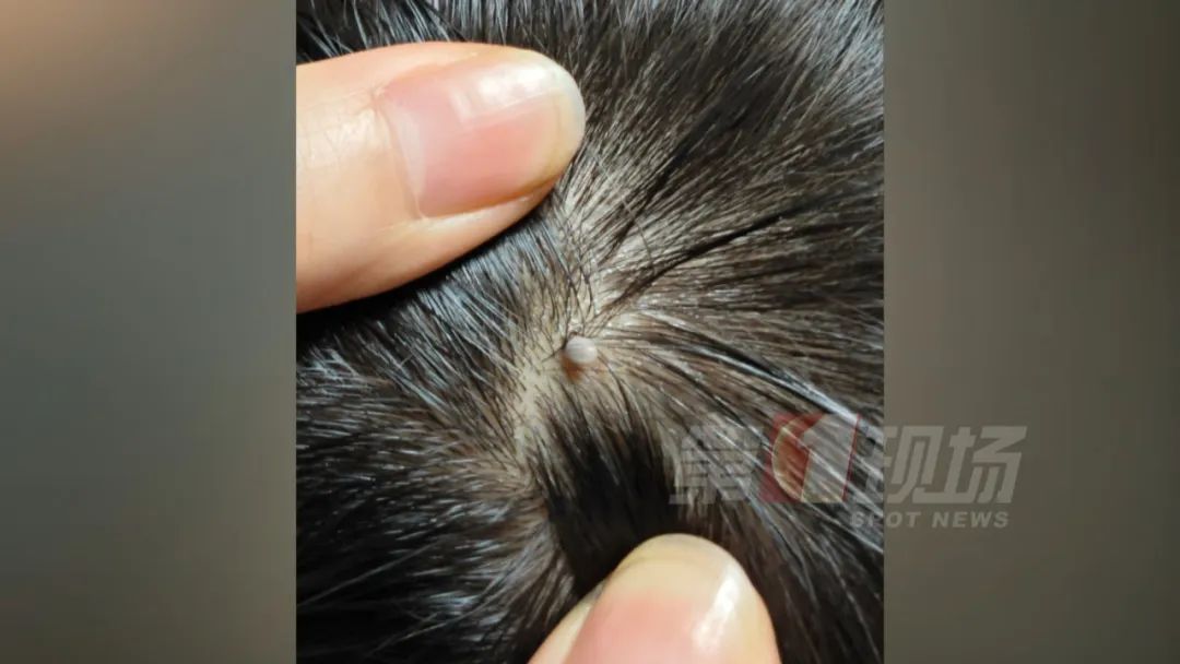 当心!逛完公园,这种“小黑点”钻进头皮...... 当心!逛完公园,这种“小黑点”钻进头皮......