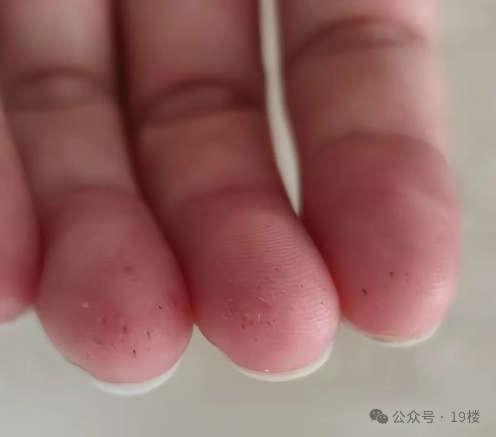 手上扎了200多针，每天吃饭提心吊胆，23岁女生确诊“老年病”……