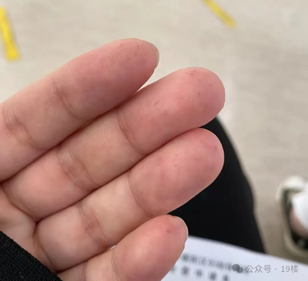 手上扎了200多针，每天吃饭提心吊胆，23岁女生确诊“老年病”……