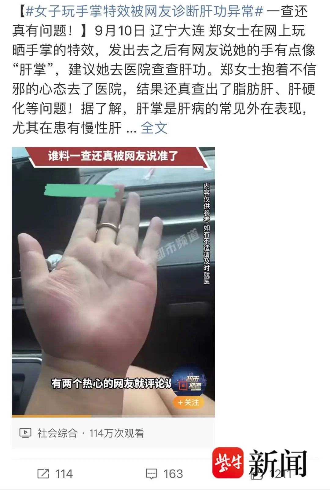 女子网上“晒手掌”，网友提醒她有肝病！医院一查，真的……