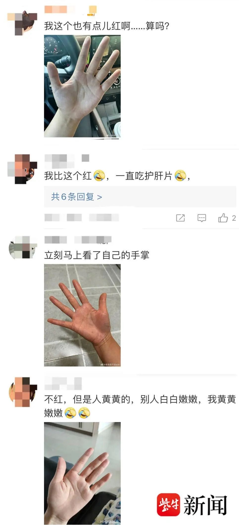 女子网上"晒手掌"!竟真查出肝硬化… 女子网上"晒手掌"!竟真查出肝硬化…