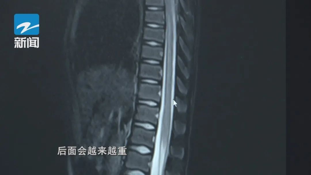 又是这一动作！8岁女孩差点瘫痪！专家提醒：10岁以下儿童尽量别做