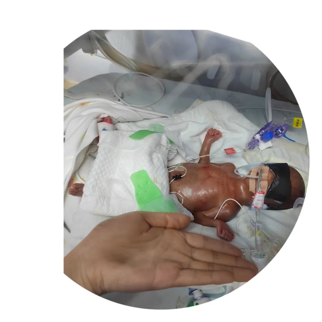 揪心!广西48岁产妇生下“巴掌宝宝”,体重仅430克…… 揪心!广西48岁产妇生下“巴掌宝宝”,体重仅430克……