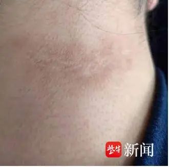 脖子上一圈“黑泥”洗不掉，不是脏而是病！