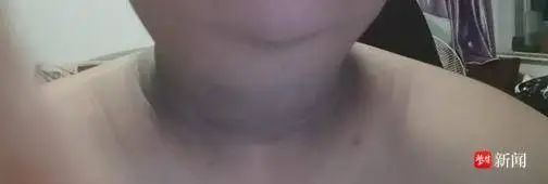 脖子上一圈“黑泥”洗不掉，不是脏而是病！